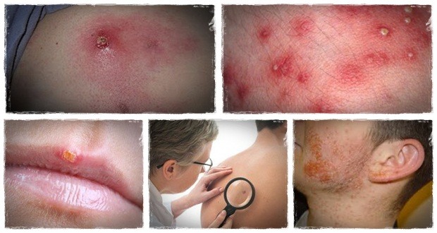 home remedies for staph infection staph infection secrets 7