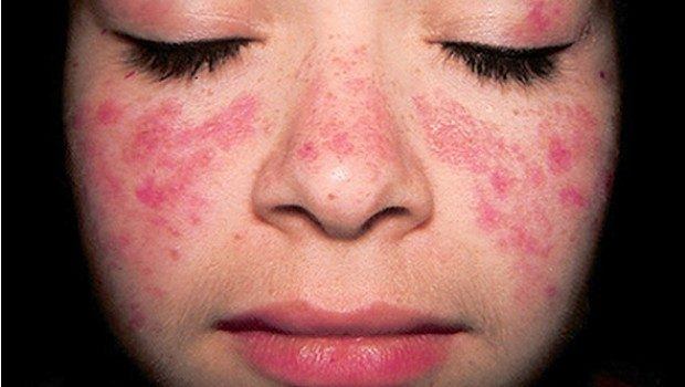 Common Skin Disorders In Toddlers And Adults Page 4