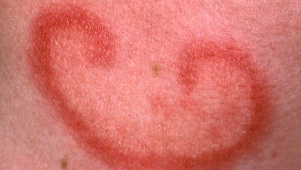 Rash Symptoms, Treatment, Causes - Contact dermatitis ...