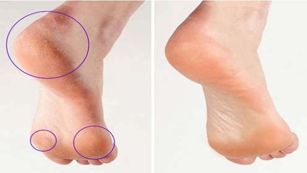 how-to-remove-calluses-from-feet-and-fingers-naturally-vkool