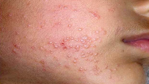 What is the itchy red patch of skin on my neck? | Zocdoc ...