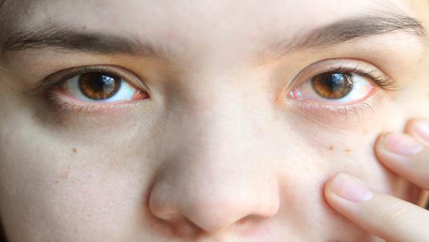 What are home remedies for treating a stye in the eye 