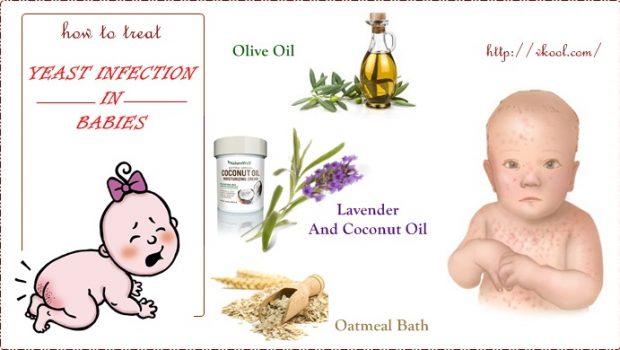 14 Methods On How To Treat Yeast Infection In Babies Naturally