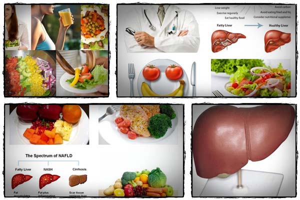 Fatty liver diet reviews