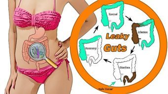 leaky gut diet