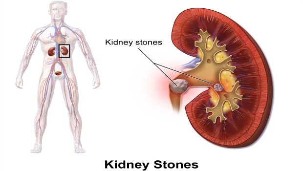 kidney stone removal report 