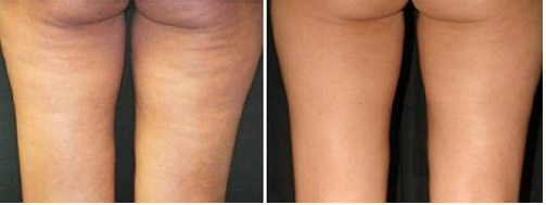 cellulite the natural care 