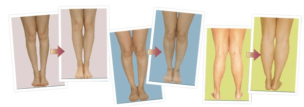 Surgery-free remedy for bow legs