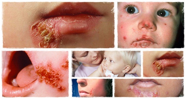 fast impetigo 