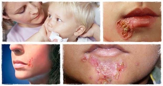 impetigo 