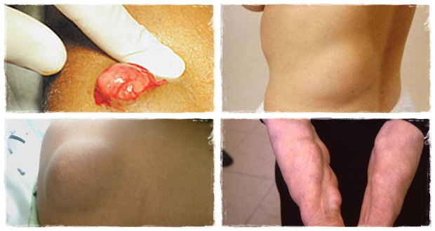 lipoma removal review