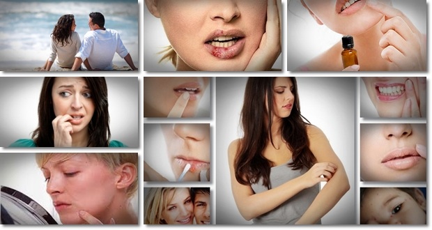 herpes treatment uk