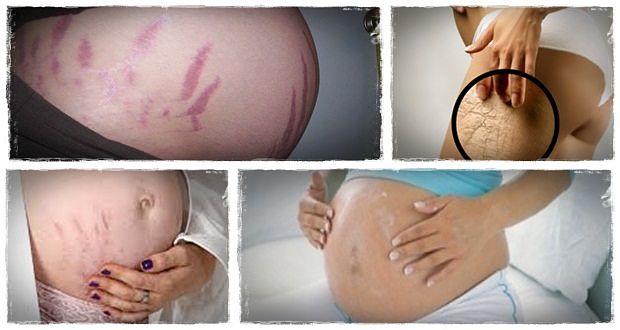 How to get rid of ugly stretch marks 1