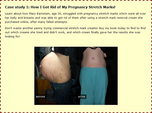 How to get rid of ugly stretch marks comment