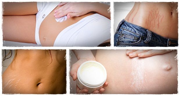 How to get rid of ugly stretch marks