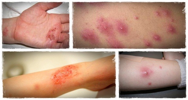 home remedies for staph infection staph infection secrets 6