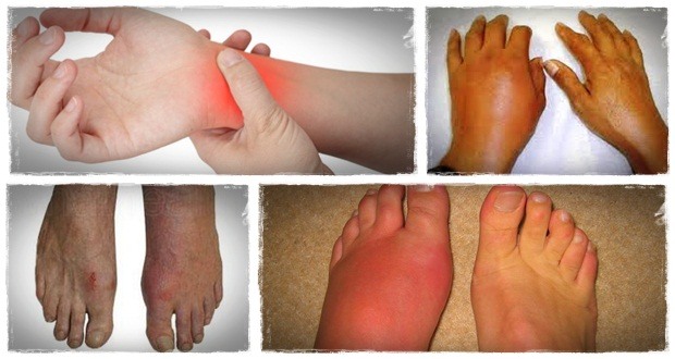how to get rid of gout the gout remedy report 6