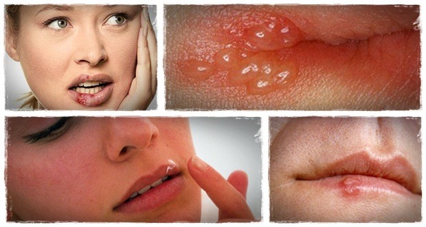 how to treat ulcers vs beat ulcers