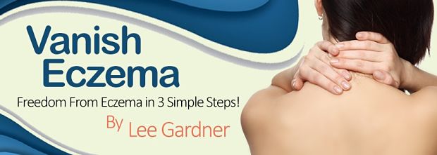 vanish eczema