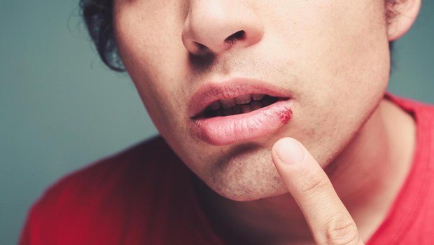 home remedies for cold sores