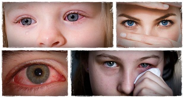 home remedies for pink eye download