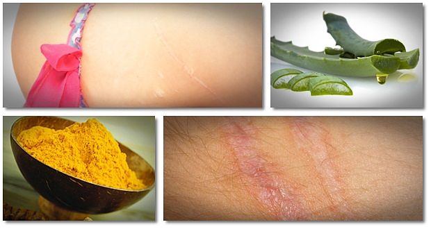 home remedies for scars from stitches