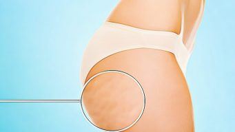how to get rid of cellulite naturally