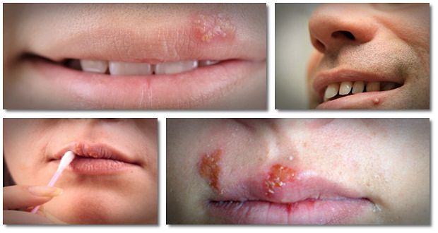 how to get rid of cold sores naturally free download