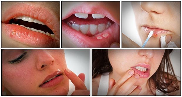 how to get rid of cold sores naturally program