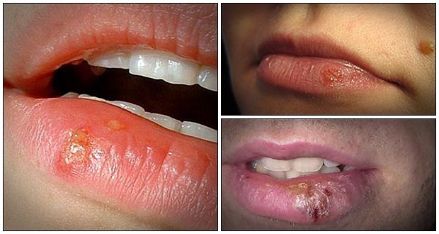 how to get rid of cold sores naturally review