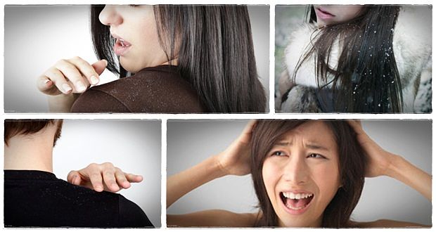 how to treat dandruff at home for women