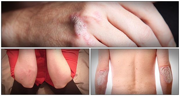 severe psoriasis treatment download