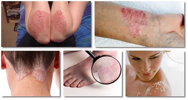 severe psoriasis treatment free download