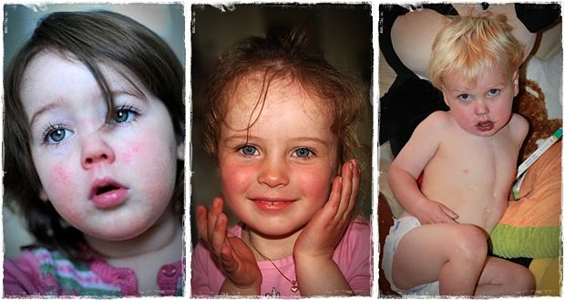 common childhood diseases pictures