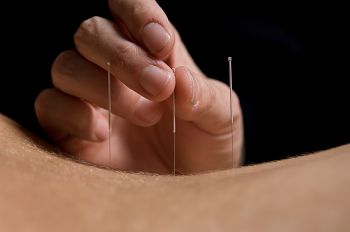 migraine headaches treatments with acupuncture