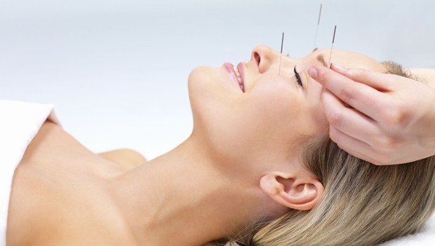 Acupuncture