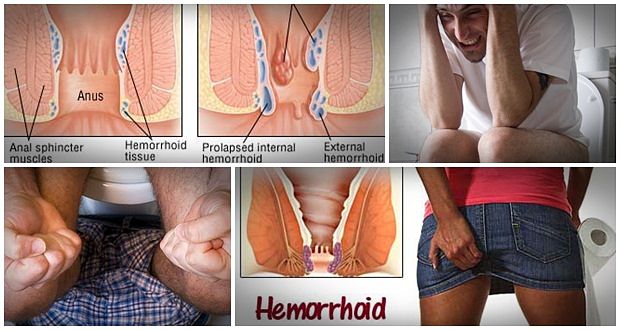 Easy hemorrhoids cure book