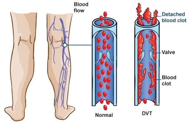 natural ways to prevent blood clots