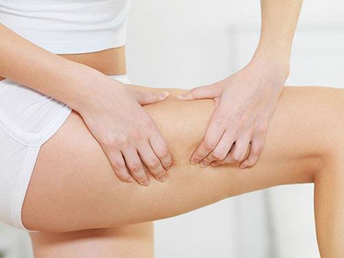 What cellulite really is: grades of cellulite