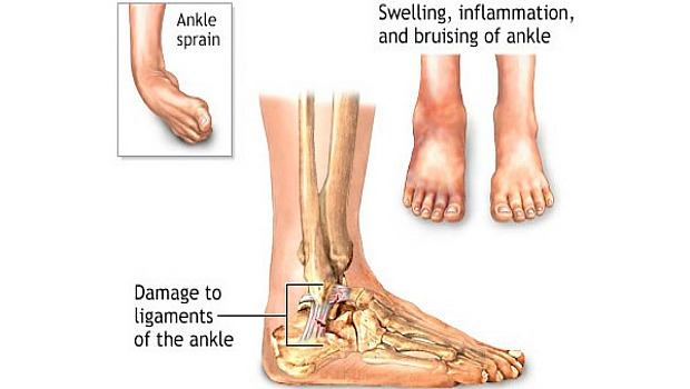 How to prevent dementia - Check out the ankle