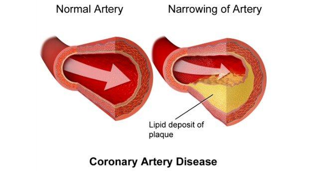 artery damage and narrowing download