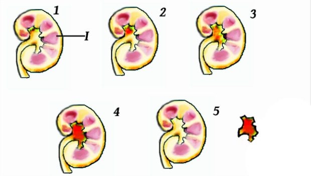different types of kidney stones download