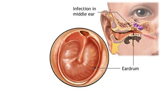 inner ear infection symptoms download
