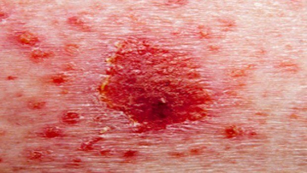 common skin disorders