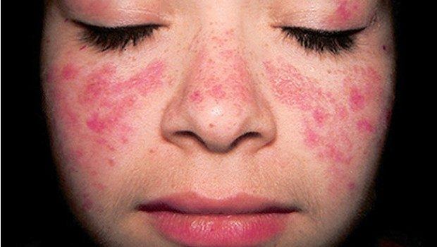 common skin disorders