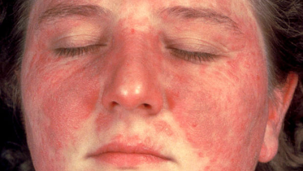 common skin disorders