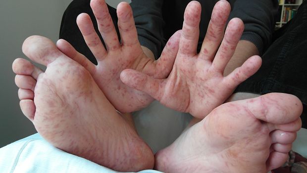 hand-foot-and-mouth disease download