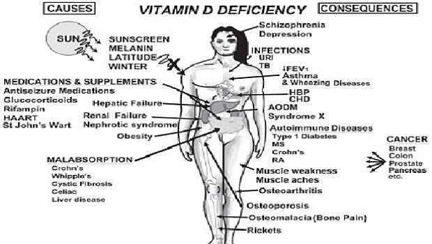 Signs of vitamin D deficiency and (7 Benefits of vitamin D 