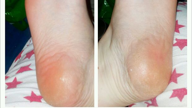 home remedies for cracked heels