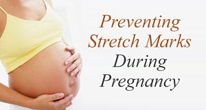 how to prevent stretch marks